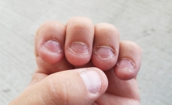 Comment arrêter de se ronger les ongles ? 7 Causes de l'onychophagie