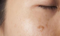 6 Remèdes naturels et efficaces contre les taches brunes sur la peau