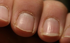 Si vous voyez cela sur vos ongles, n’hésitez pas à consulter rapidement un médecin !