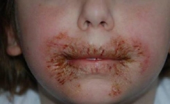 Les médecins tirent la sonnette d’alarme. Ne jamais nettoyer le visage de votre enfant avec des lingettes !!
