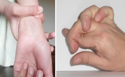 Si vous pouvez faire ça avec vos mains, vous pourriez avoir le syndrome de Marfan