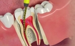 Tout savoir sur le traitement canalaire et le canal radiculaire : Un dentiste expert vous explique tout !