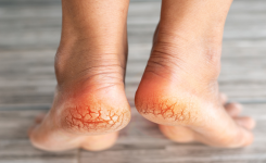 4 remèdes naturels pour traiter les pieds secs et crevassés :