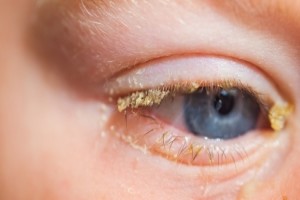 Croûte jaune sur les yeux 