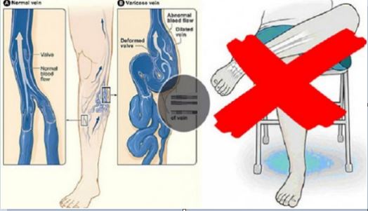 Pourquoi Vous Devriez Arrêter de Croiser les Jambes : 5 Raisons qui Vont Vous Convaincre »