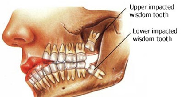 Les dents de sagesse : Voici pourquoi vous en avez besoin !