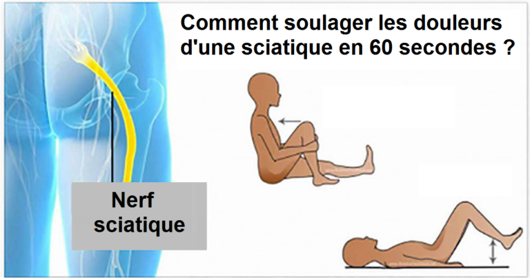Comment soulager les douleurs d’une sciatique rapidement ?