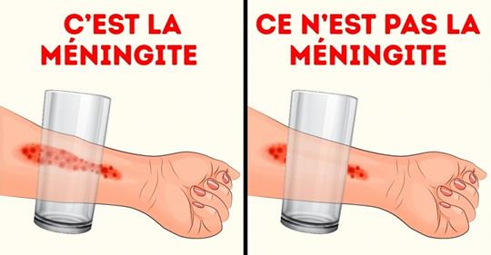 Les parents ne devraient pas ignorer ces 8 symptômes de la méningite